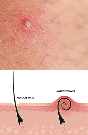 Will Laser Hair Removal Help with Ingrown Hairs?