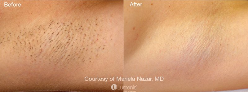 Will Laser Hair Removal Help with Ingrown Hairs?
