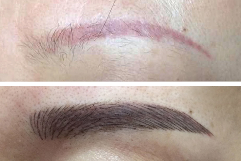 Does Microblading Cause Scarring?